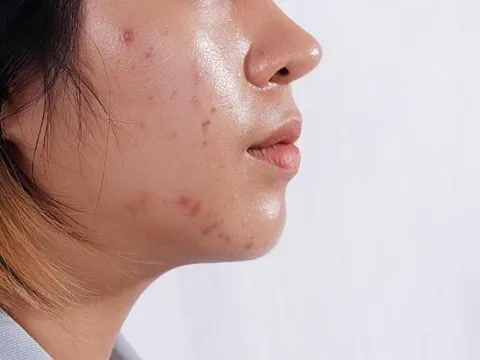 Cải thiện tình trạng da bóng do tiết dầu ngày hè