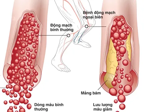 Khám và tư vấn miễn phí bệnh động mạch chi dưới mạn tính
