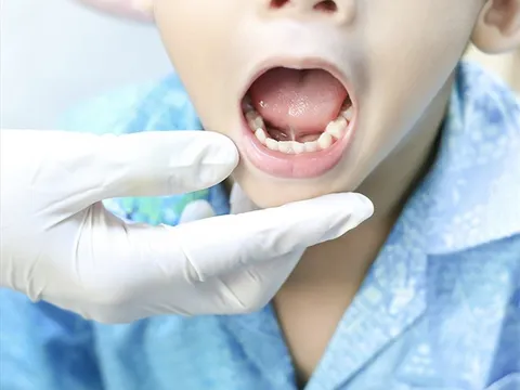 Cần điều trị sớm tật dính thắng lưỡi cho trẻ