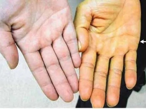 7 dấu hiệu chứng tỏ gan đang có vấn đề, cần đi khám ngay