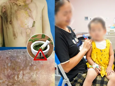 Tự ý điều trị bỏng cho con bằng phương pháp dân gian gây biến chứng nặng