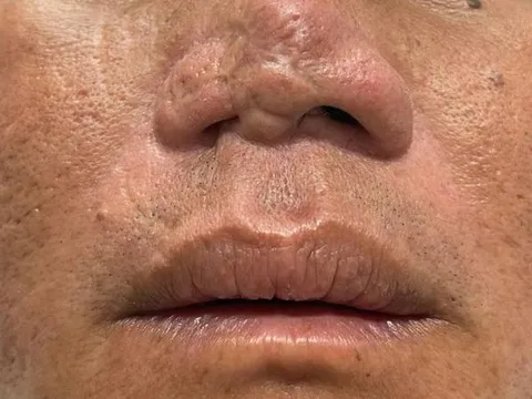 TP HCM: Điều trị miễn phí cho bị co rút tay chân, hở hàm ếch