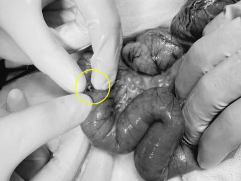 Bé gái 3 tuổi thủng ruột vì nuốt 3 viên bi nam châm