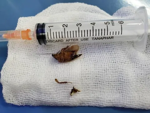 Vĩnh Phúc: Bác sĩ gắp ve chó, gián còn sống trong tai bệnh nhân