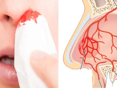 Cẩn trọng khi bị chảy máu cam thường xuyên