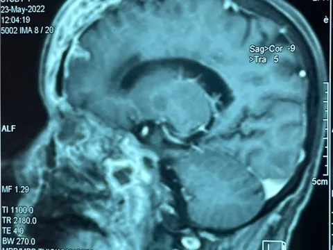 Kết luận nguyên nhân gây bệnh hoại tử xương hàm mặt sau mắc Covid-19