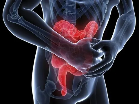 Điều trị bệnh viêm dạ dày ruột cấp thế nào?