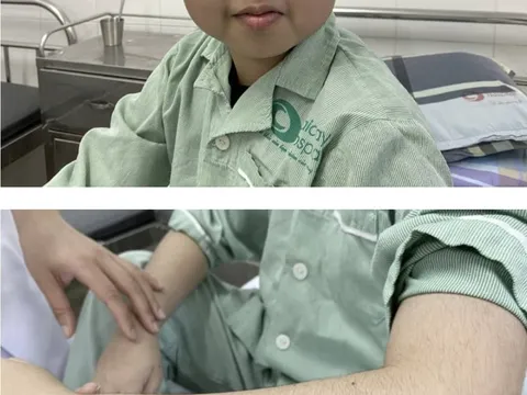 Cảnh báo trẻ bị suy tuyến thượng thận do dùng thuốc xịt mũi có corticoid sai cách