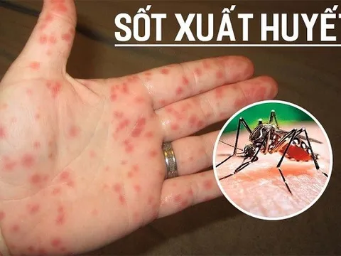 Thủ tướng ra Công điện tăng cường các biện pháp phòng chống sốt xuất huyết