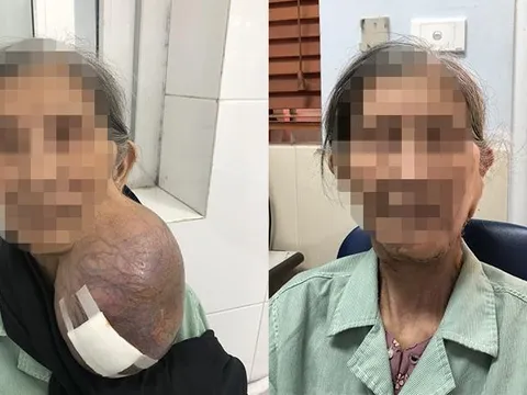 Phẫu thuật thành công khối u “khủng” trên cổ cụ bà đã hơn 40 năm