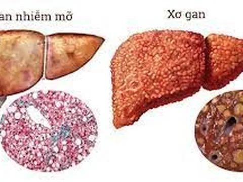 Giới khoa học Bồ Đào Nha phát hiện phân tử có thể ngăn ngừa bệnh gan nhiễm mỡ 