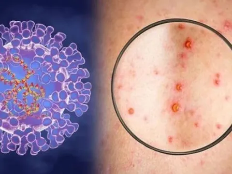 Việt Nam nghiên cứu sản xuất thuốc phòng, chống đậu mùa khỉ