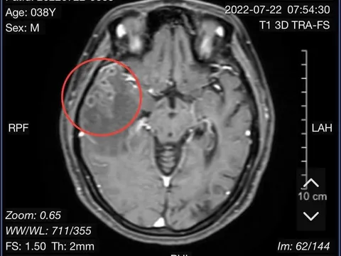 Phát hiện sán cư trú trong não người phụ nữ sau cơn đau đầu