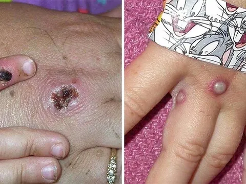 Hà Nội:  Kiểm soát, phòng chống đậu mùa khỉ "sớm một bước, cao hơn một bước”