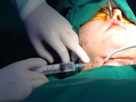 Tỷ lệ bệnh nhân bị tai biến ngày càng tăng do làm đẹp tại các cơ sở y tế chui