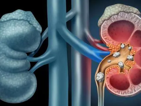 Thay đổi lối sống và chế độ ăn uống để phòng ngừa sỏi thận tái phát