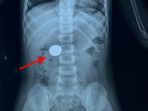 Phú Thọ: Thiếu niên phải nhập viện cấp cứu do nuốt phải hạt mít