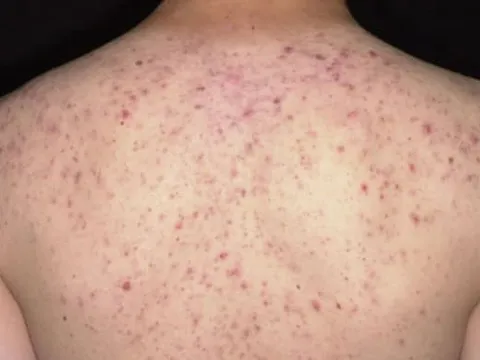 Suýt tử vong vì trị mụn trứng cá ở lưng tại một spa