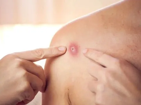 Cách phòng ngừa lây nhiễm bệnh đậu mùa khỉ tại cơ sở y tế