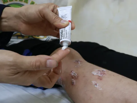 Bệnh chốc - nỗi ám ảnh của trẻ khi đến trường