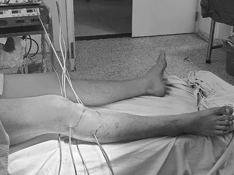 Nam thanh niên bị 5 thanh sắt đâm xuyên chân