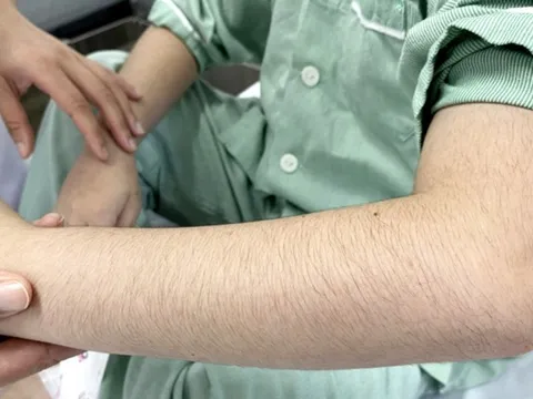 Hậu quả khôn lường từ việc lạm dụng thuốc corticoid