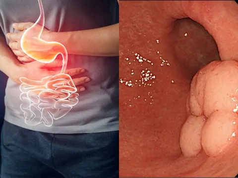 Bệnh ung thư dạ dày được phát hiện sớm, tỉ lệ điều trị thành công lên tới hơn 90%