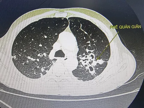Thói quen hút thuốc lá - Nguyên nhân chính gây nên các bệnh tật có tỷ lệ tử vong cao hàng đầu trên thế giới