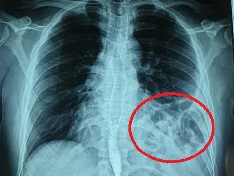 Nghĩ bị hậu Covid-19, đi khám thì được phát hiện vỡ cơ hoành