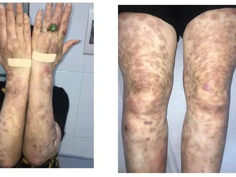 Bệnh phong để lại di chứng trầm trọng nếu không được phát hiện và điều trị kịp thời