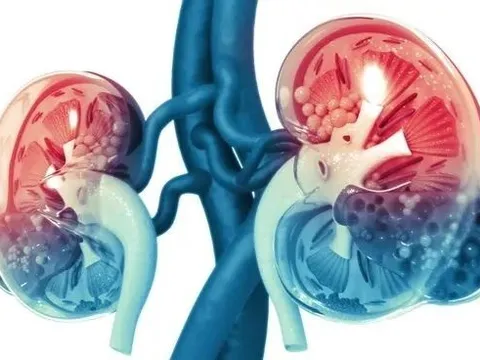 Phát hiện sớm tổn thương ở thận gây nguy cơ ung thư
