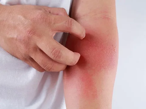 Cách phòng bệnh viêm da mủ khi thời tiết nóng nực