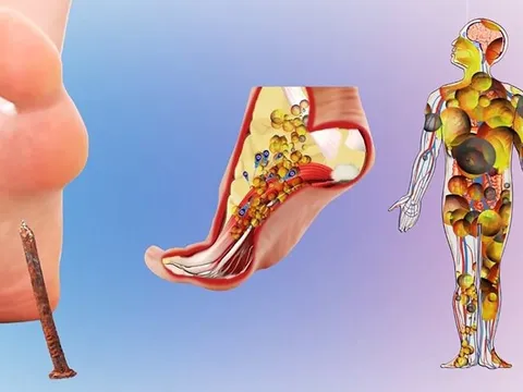 Vết thương nhỏ cũng có thể gây uốn ván