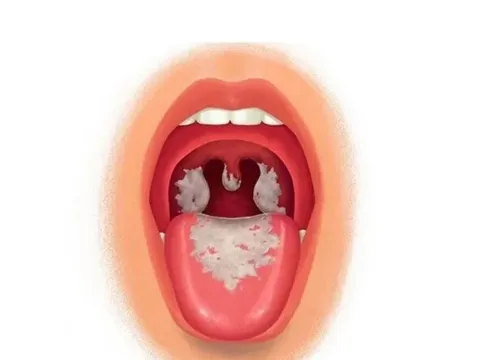 TP.HCM đủ vaccine bạch hầu để tiêm cho người dân có nhu cầu