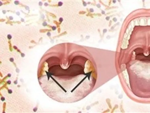 Bộ Y tế yêu cầu khẩn trương giám sát, phát hiện sớm, xử lý triệt để ổ bệnh bạch hầu
