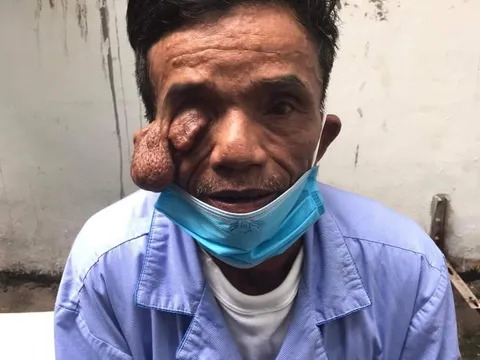 Quảng Bình: Phẫu thuật thành công khối u 30 năm tuổi